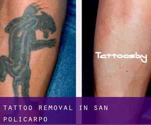 Tattoo Removal in San Policarpo
