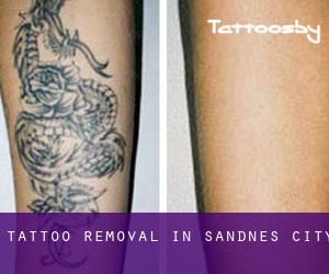 Tattoo Removal in Sandnes (City)