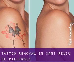 Tattoo Removal in Sant Feliu de Pallerols