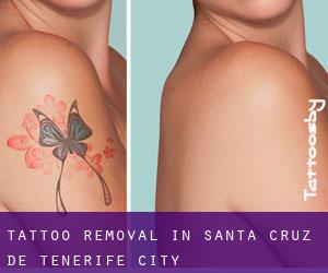 Tattoo Removal in Santa Cruz de Tenerife (City)