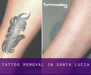 Tattoo Removal in Santa Lucía
