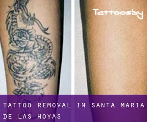 Tattoo Removal in Santa María de las Hoyas