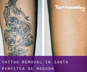 Tattoo Removal in Santa Perpètua de Mogoda