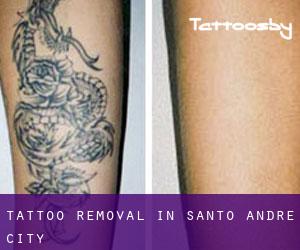 Tattoo Removal in Santo André (City)