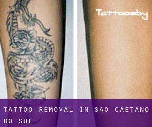 Tattoo Removal in São Caetano do Sul