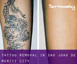 Tattoo Removal in São João de Meriti (City)