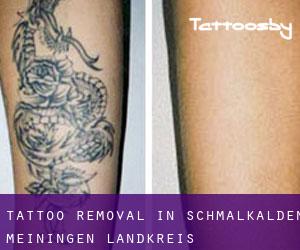Tattoo Removal in Schmalkalden-Meiningen Landkreis