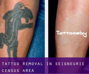 Tattoo Removal in Seigneurie (census area)
