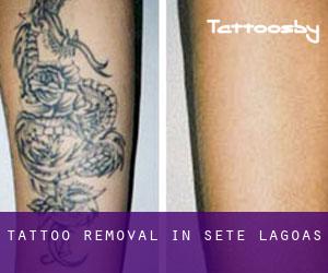Tattoo Removal in Sete Lagoas