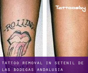 Tattoo Removal in Setenil de las Bodegas (Andalusia)
