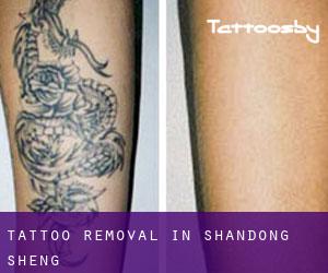 Tattoo Removal in Shandong Sheng