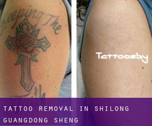 Tattoo Removal in Shilong (Guangdong Sheng)