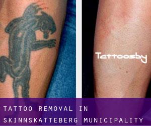Tattoo Removal in Skinnskatteberg Municipality
