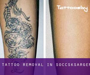 Tattoo Removal in Soccsksargen