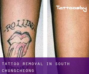 Tattoo Removal in South Chungcheong