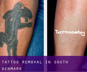Tattoo Removal in South Denmark