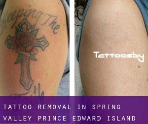 Tattoo Removal in Spring Valley (Prince Edward Island)