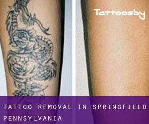 Tattoo Removal in Springfield (Pennsylvania)