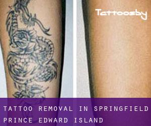 Tattoo Removal in Springfield (Prince Edward Island)