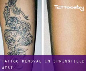 Tattoo Removal in Springfield West