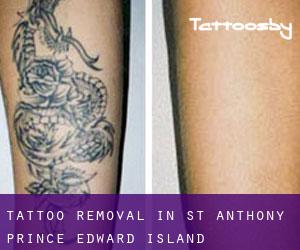 Tattoo Removal in St. Anthony (Prince Edward Island)