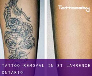 Tattoo Removal in St. Lawrence (Ontario)