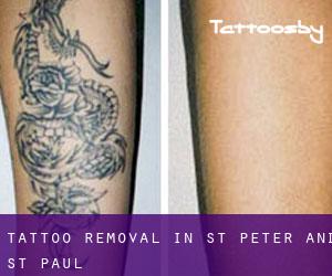 Tattoo Removal in St. Peter and St. Paul
