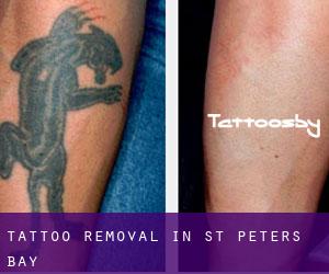 Tattoo Removal in St. Peters Bay