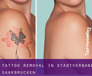 Tattoo Removal in Stadtverband Saarbrücken