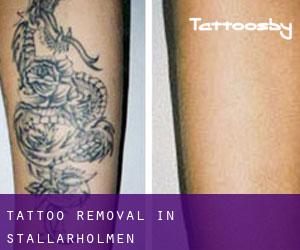 Tattoo Removal in Stallarholmen