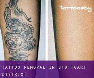 Tattoo Removal in Stuttgart District