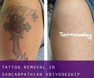 Tattoo Removal in Subcarpathian Voivodeship