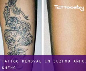 Tattoo Removal in Suzhou (Anhui Sheng)