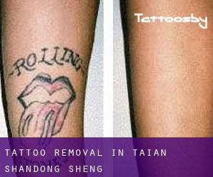 Tattoo Removal in Tai'an (Shandong Sheng)