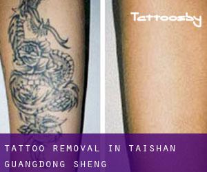 Tattoo Removal in Taishan (Guangdong Sheng)
