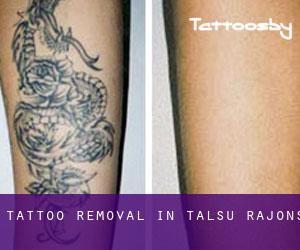 Tattoo Removal in Talsu Rajons