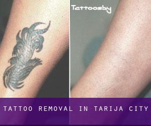 Tattoo Removal in Tarija (City)