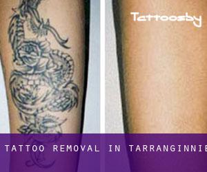 Tattoo Removal in Tarranginnie