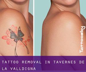 Tattoo Removal in Tavernes de la Valldigna