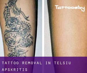 Tattoo Removal in Telšių Apskritis