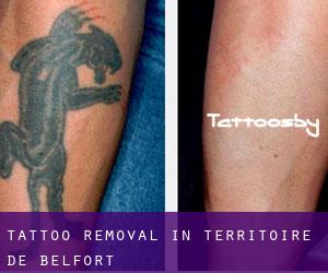 Tattoo Removal in Territoire de Belfort
