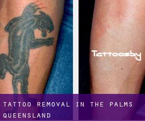 Tattoo Removal in The Palms (Queensland)