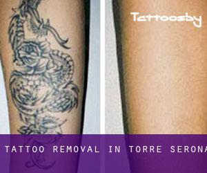 Tattoo Removal in Torre-serona