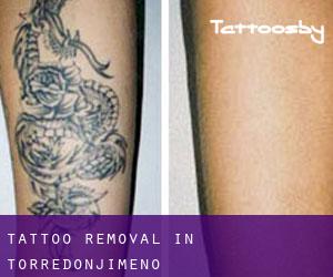 Tattoo Removal in Torredonjimeno