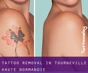 Tattoo Removal in Tourneville (Haute-Normandie)