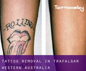 Tattoo Removal in Trafalgar (Western Australia)