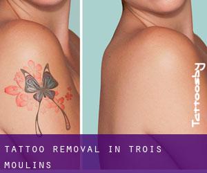 Tattoo Removal in Trois-Moulins