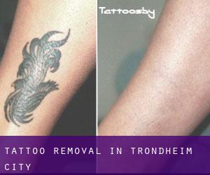 Tattoo Removal in Trondheim (City)
