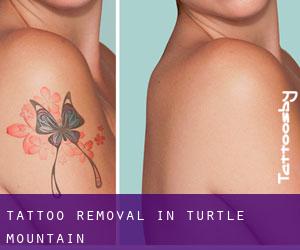 Tattoo Removal in Turtle Mountain