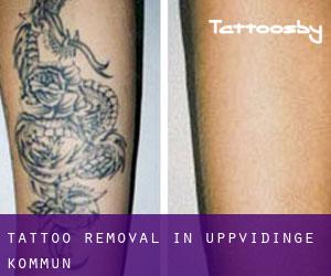 Tattoo Removal in Uppvidinge Kommun
